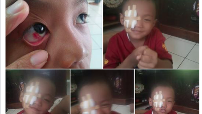 Keseringan Main Gadget, Mata Si Kecil Alami Perdarahan Keseringan Main Gadget, Mata Si Kecil Alami Perdarahan