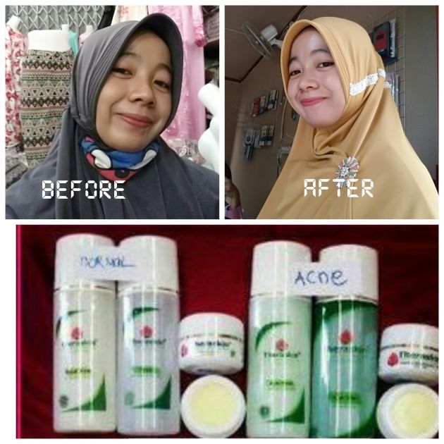 Pengalaman Pribadi Memakai Paket Theraskin Pengalaman Pribadi Memakai Paket Theraskin
