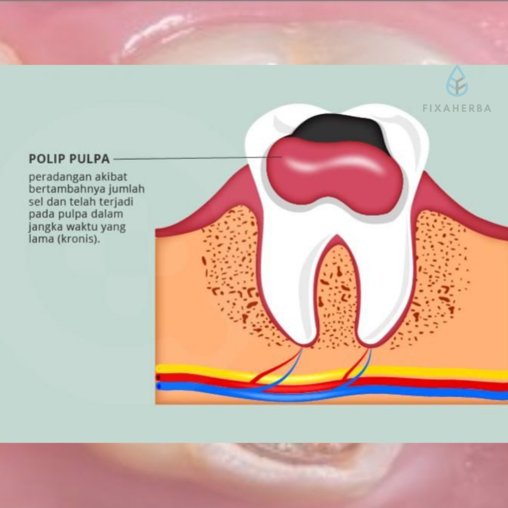Hati-hati! Gigi Berlubang Dapat Sebabkan Pulpa Polip!