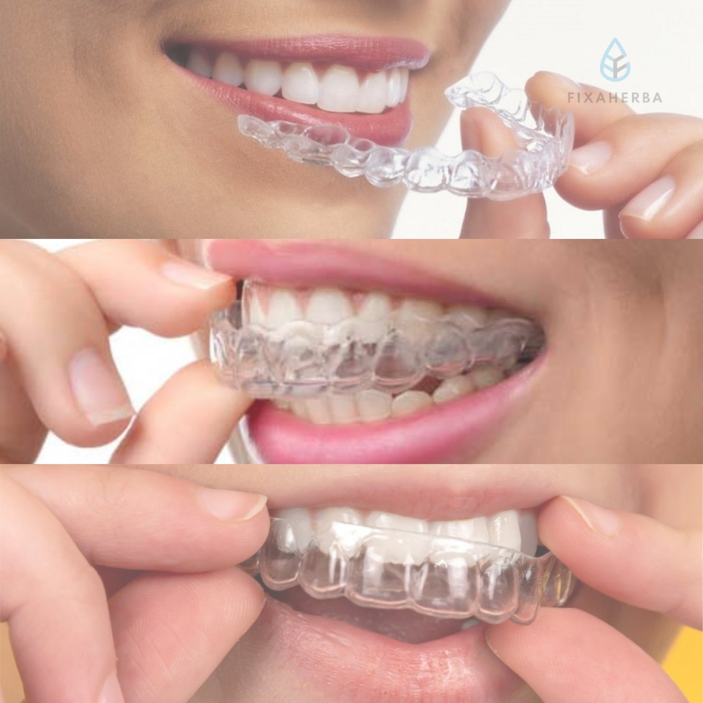 clear aligner