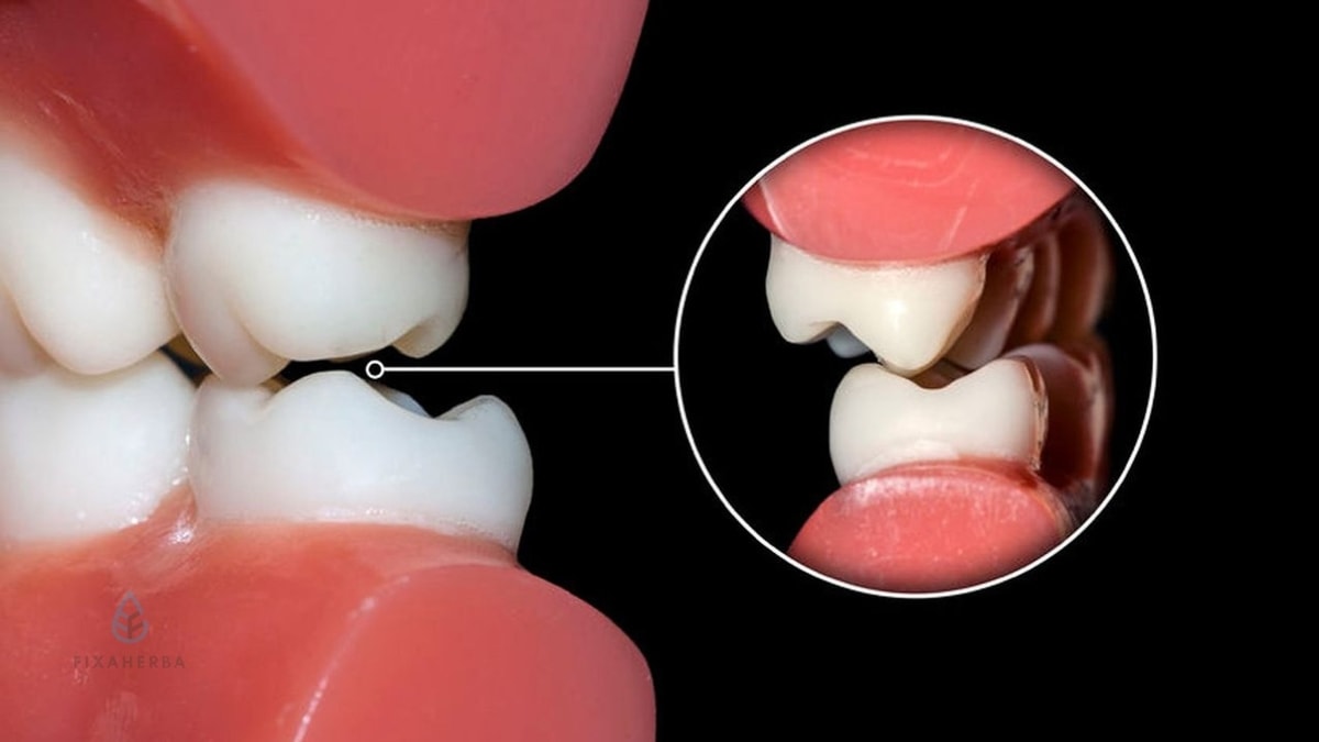 Apa itu Bruxism? Lihat Penyebab Dan Penanganannya!