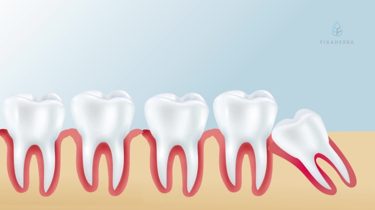 Jangan Sepelekan Impaksi Gigi Bungsu! Cek Prosedur Perawatannya!