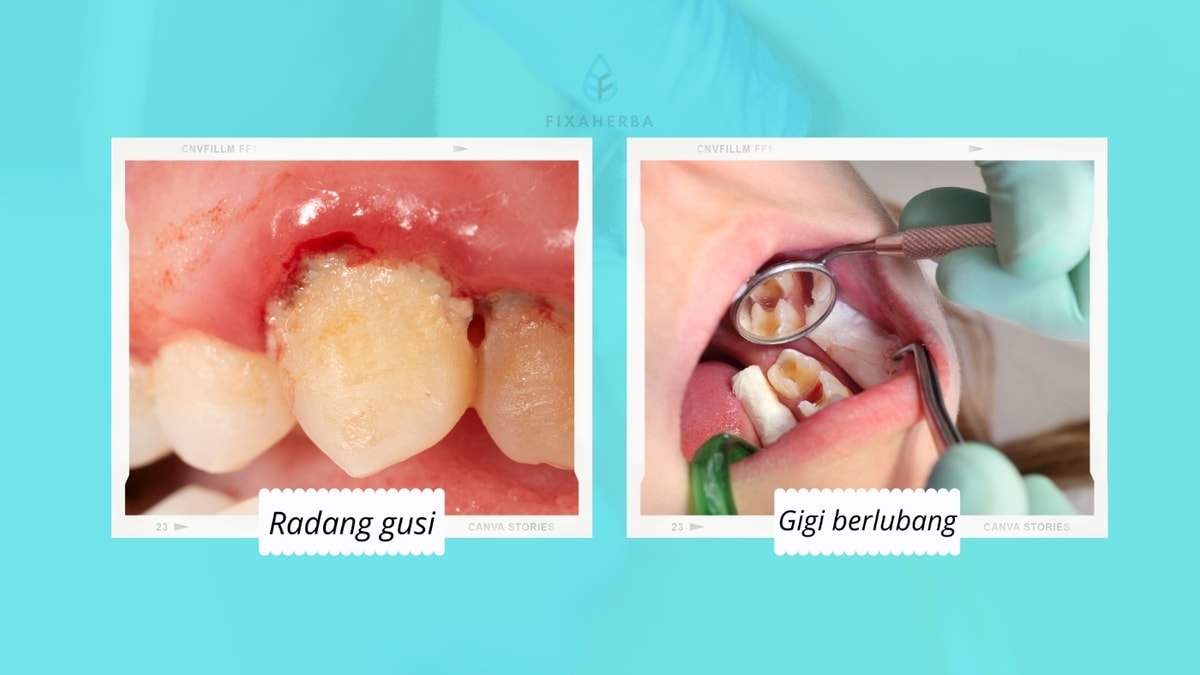 radang gusi & gigi berlubang