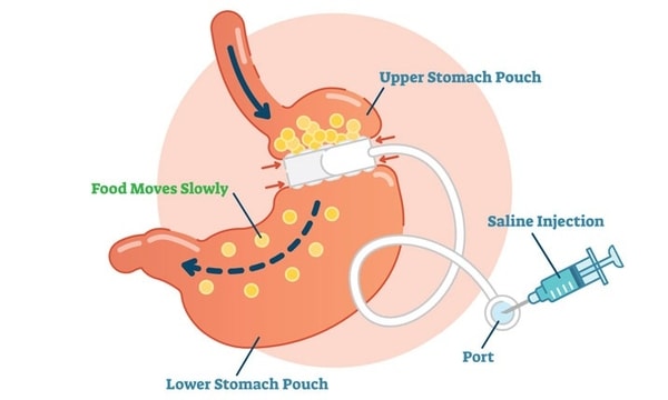 Mengenal Operasi Bariatric Yang Baru Dijalani Melly Goeslaw!